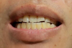 Veneers for Chipped Teeth