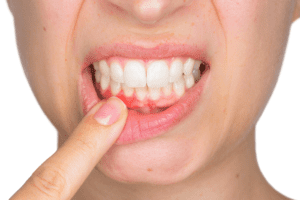 An image of a lady showing her gums