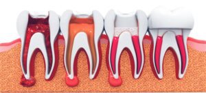 Root-Canal Treatment In Gold Coast