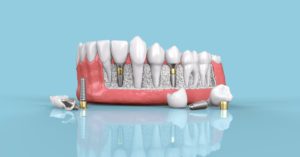 tooth dental implant model 3d illustration