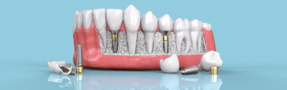 What to Expect Before, During & After Getting Dental Implants