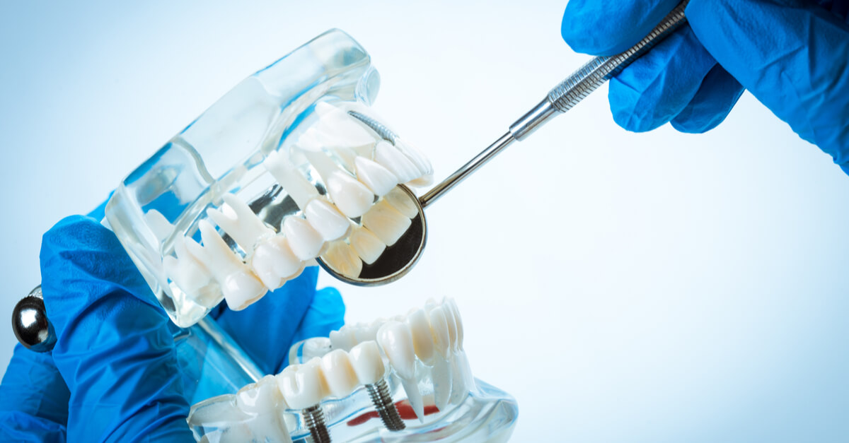 A Guide to Dental Implants – Crowns, Bridges and Implants