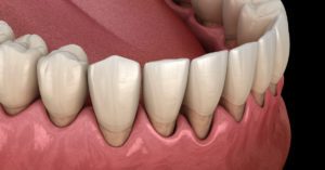 3D Illustration of Gum Recession Process by Dentists on the Gold Coast