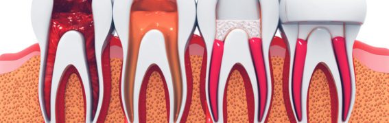 How to Recover From Root-Canal Treatment: At-Home Care