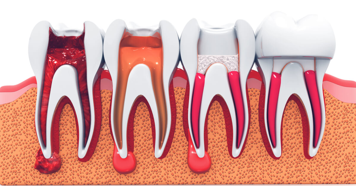 How to Recover From Root-Canal Treatment: At-Home Care