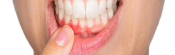 How Stress Affects Your Teeth and Gums