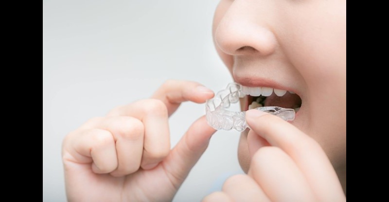 inserting invisalign