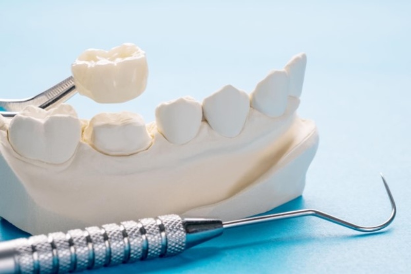 Dental Bridge vs Implant
