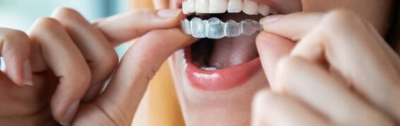 Invisalign vs. Braces: Which Is Right for You?