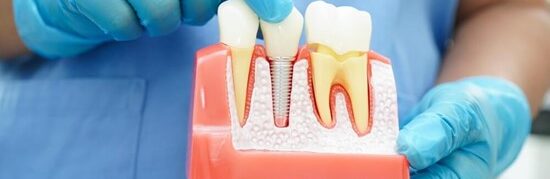 Temporary vs Permanent Dental Crowns: What’s the Difference?