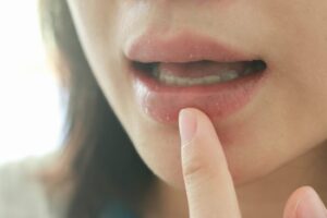 Dry Mouth (Xerostomia) – Causes & Treatment Explained by The Dentist on the Gold Coast