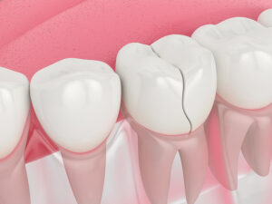 Cracked Tooth Repair Treatment by the Dentist on the Gold Coast