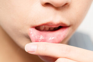 Mouth Ulcers Treatment by the Dentist on the Gold Coast