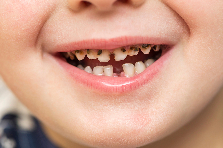 Tooth Decay Treatment by the Dentist on the Gold Coast