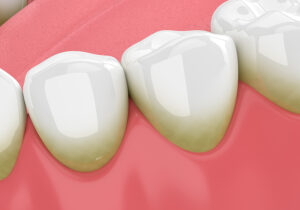 Tooth Discolouration Treatment by the Dentist on the Gold Coast
