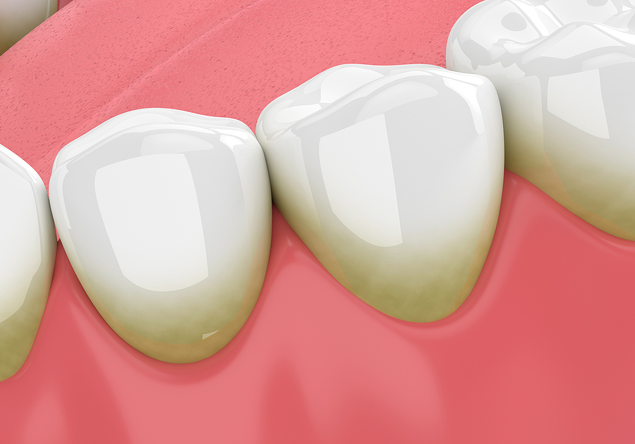 Tooth Discolouration Treatment by the Dentist on the Gold Coast