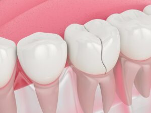 Cracked Tooth Repair Treatment on the Gold Coast